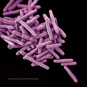 Medical illustration of tuberculosis.