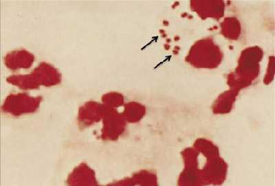 Figure 1 is a picture of a gram stain of N. meningitidis in cerebrospinal fluid (CSF) with associated polymorphonuclear leukocytes (PMNs).