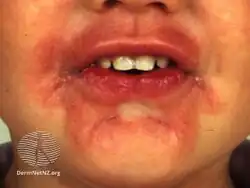 Lip licker's dermatitis