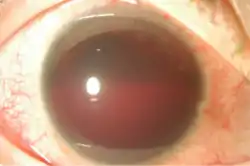 Near total hyphema (grade IV)