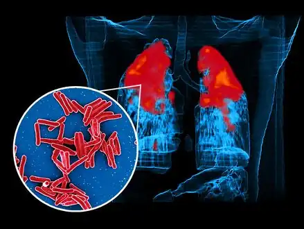 Scanning electron micrograph of Mycobacterium tuberculosis bacteria, which cause TB foreground image and a PET/CT scan showing TB infection (red) in an individuals lungs background image