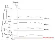 Schematic of manometry in achalasia showing aperistaltic contractions, increased intraesophageal pressure, and failure of relaxation of the lower esophageal sphincter.