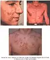 Some more severe pimples can lead to significant swelling and may appear on the back and chest.