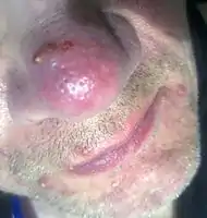 Rosacea on the face