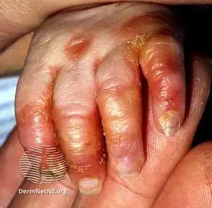 Acrodermatitis enteropathica