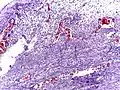 Micrograph of appendicitis showing neutrophils in the muscularis propria. H&E stain.