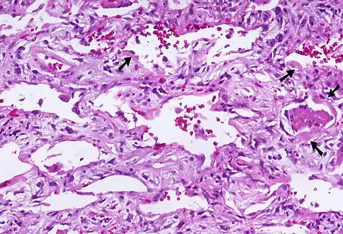 Acute interstitial pneumonia (AIP)/Idiopathic DAD