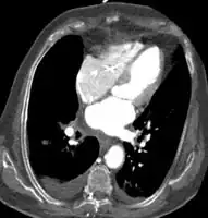 Acute myocardial infarction