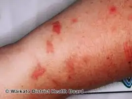 Phytophotodermatitis