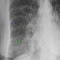 Acute pulmonary edema