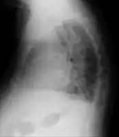 Acute pulmonary edema lateral