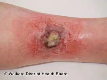 Acute radiation dermatitis