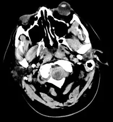 Acute subarachnoid hemorrhage