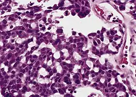 Cell-block preparation from a fine-needle aspiration biopsy of a large ACC shows tumor cells with compact, eosinophilic cytoplasm and a mild degree of nuclear pleomorphism.