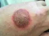 Aerosol induced frostbite