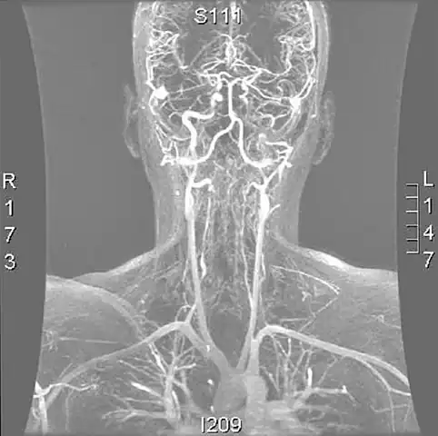 Magnetic resonance angiogram of the neck vessels in a person with Ehlers-Danlos syndrome type IV; it shows a dissection of the left internal carotid artery, dissection of both vertebral arteries in their V1 and V2 segments and a dissection of the middle and distal third of the right subclavian artery. Such striking episodes of dissection are typical for this "vascular" subtype of Ehlers-Danlos syndrome.