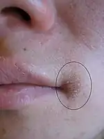 Angular cheilitis