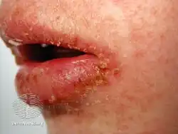 Angular cheilitis