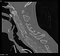 CT scan showing bamboo spine in ankylosing spondylitis