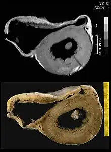 In vitro MRI and corresponding cross section of the heart in ARVD show RV dilatation with anterior and posterior aneurysms (17-year-old asymptomatic male athlete who died suddenly during a soccer game).