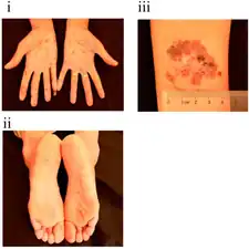 Pigmentation, de-pigmentation and hyperkeratosis