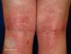 Atopic dermatitis