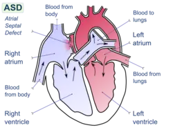 Diagram of the four chambers of the heart. There is a gap in the wall between the upper-left and upper-right chambers