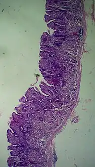 Atrophic gastritis under low power. H&E stain.