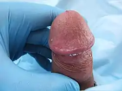 Balanitis caused by smegma