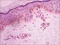 Stratum corneum with characteristic normal basket weave appearance, normal epidermis and basal cell layer.