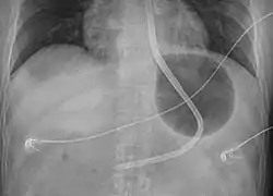 A Blakemore tube inflated in the stomach