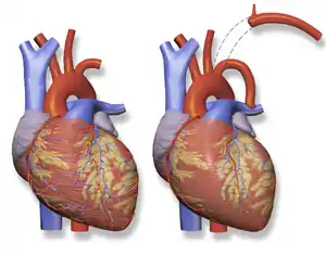 Blalock Taussig Shunt - Left subclavian artery to left pulmonary artery.