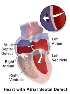 Atrial Septal Defect (ASD)