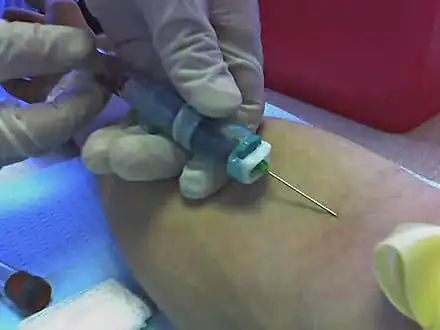 A venipuncture performed using a vacutainer