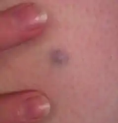 Blue nevus