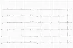 Electrocardiogram from a man with tachycardia-bradycardia syndrome following mitral valvuloplasty, resection of the left atrial appendage, and maze procedure. The ECG shows AV-junctional rhythm resulting in bradycardia at around 46 beats per minute.