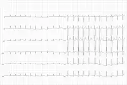 This ECG from the same patient shows atrial fibrillation at around 126 beats per minute.