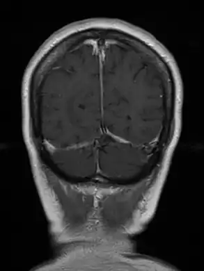 Cerebral toxoplasmosis