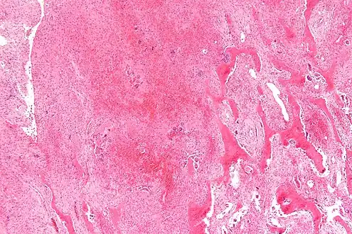 Micrograph of a brown tumor (left of image). H&E stain.