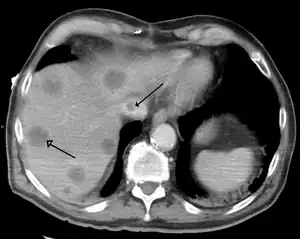 Budd-chiari syndrome