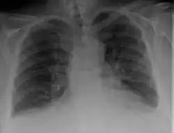 Congestive heart failure with small bilateral effusions.