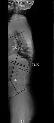 TK: Thoracic kyphosis- Measurements of spinopelvic parameters