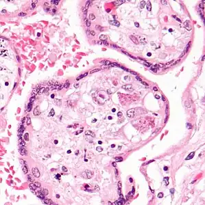 CMV placentitis, one cell has characteristic large nucleus with peri-nuclear clearing,  two cells have characteristic viral inclusion bodies