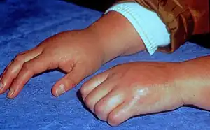 CRPS visible on hands and wrists