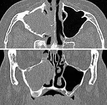 CT scan of chronic sinusitis, showing a filled right maxillary sinus with sclerotic thickened bone.