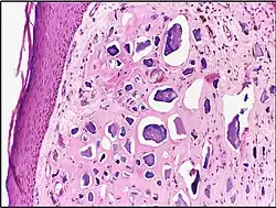 Calcinosis cutis in human tissue