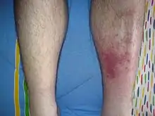 Infected left shin in comparison to the right sided shin with no sign of symptoms.