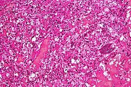 Micrograph of cerebellar hemangioblastoma. HPS stain.