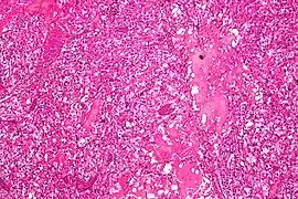 Micrograph of cerebellar hemangioblastoma. HPS stain.