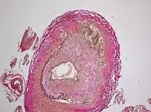 Histopathology of giant cell vasculitis in a cerebral artery. Elastica-stain.